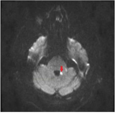 Acute Stroke in Middle Cerebellar Peduncle in a Patient With FXTAS